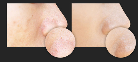 Real Vitamin C Ampoule Nose Before After Image